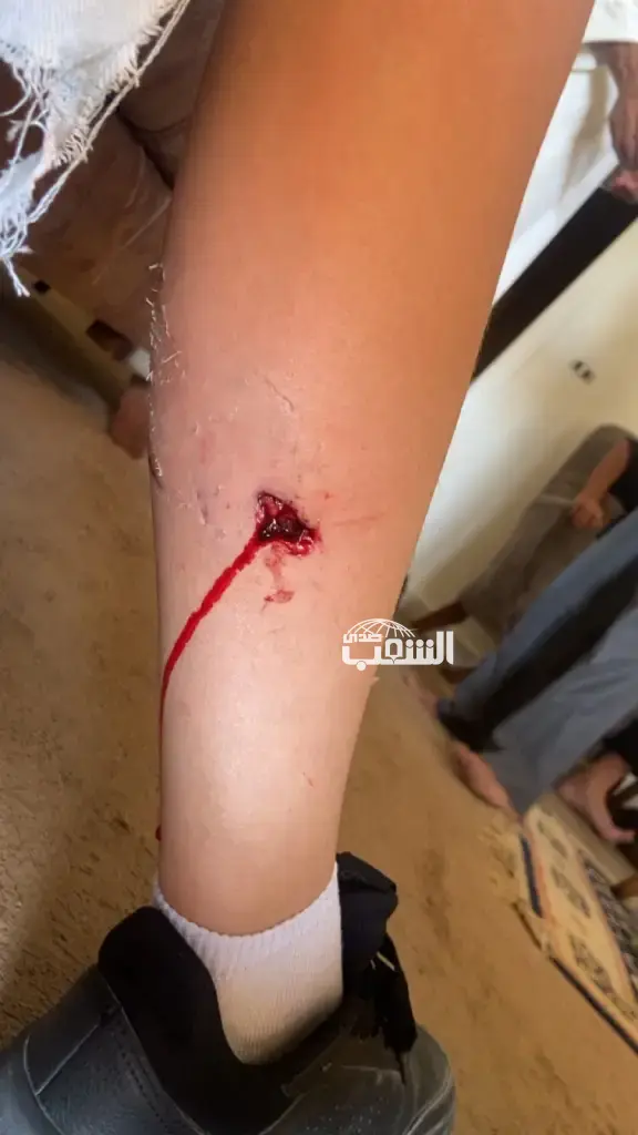 كلب "يعقر" طفلاً بعد خروجه من مدرسته في "القسطل"